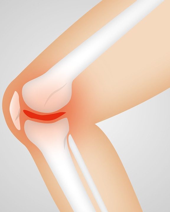 Comment soulager les douleurs de l’arthrose du genou ?